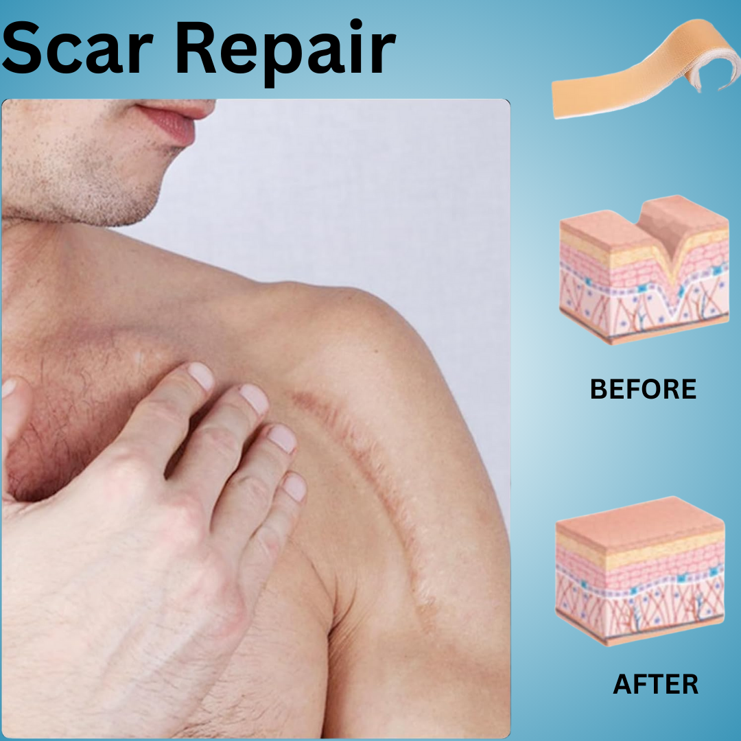 Silicone Scar Sheets