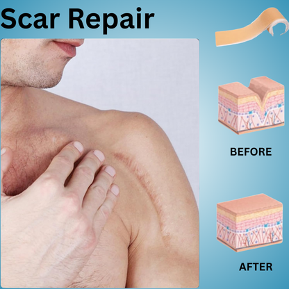 Silicone Scar Sheets