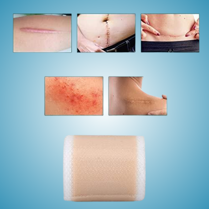 Silicone Scar Sheets